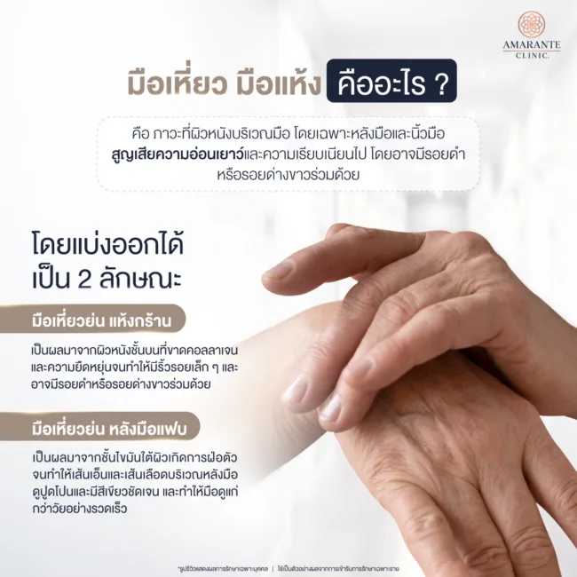 มือเหี่ยว และมือแห้ง คืออะไร​
