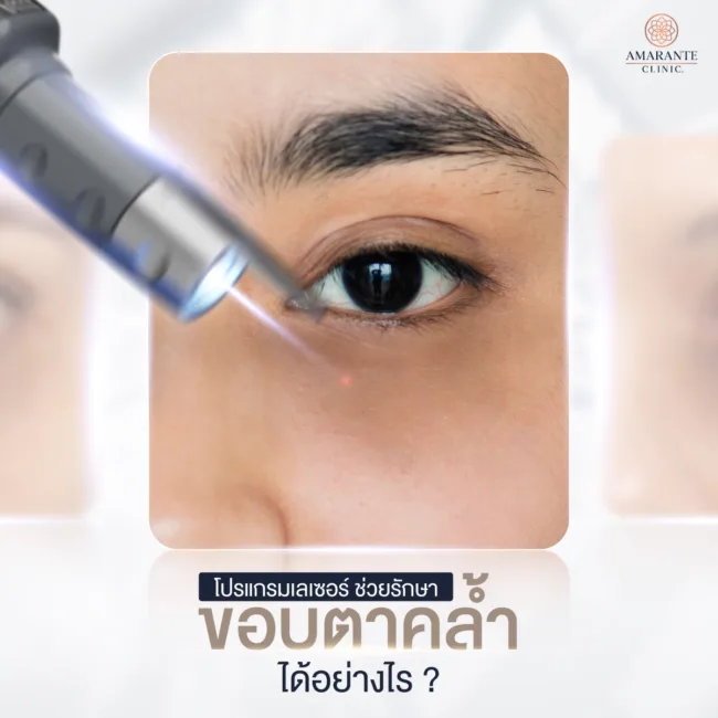 Laser ช่วยรักษาขอบตาคล้ำได้อย่างไร