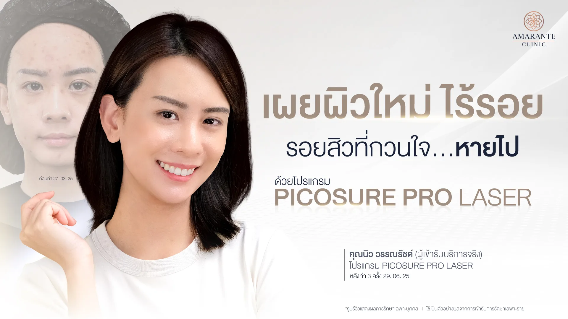รีวิว PICOSURE คุณนิว วรรณรัชต์ ร้อยสิวที่กวนใจหายไปด้วย Picosure Pro