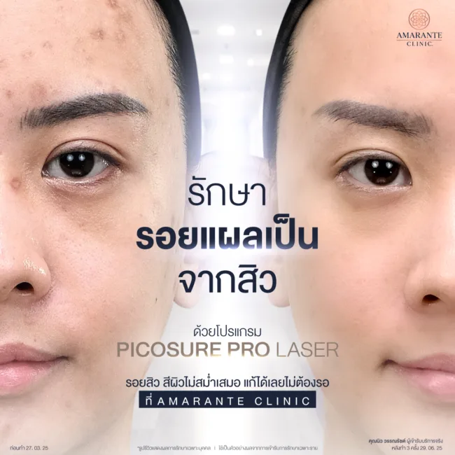 รีวิวก่อนหลัทำPicosure Proที่Amarante Clinic