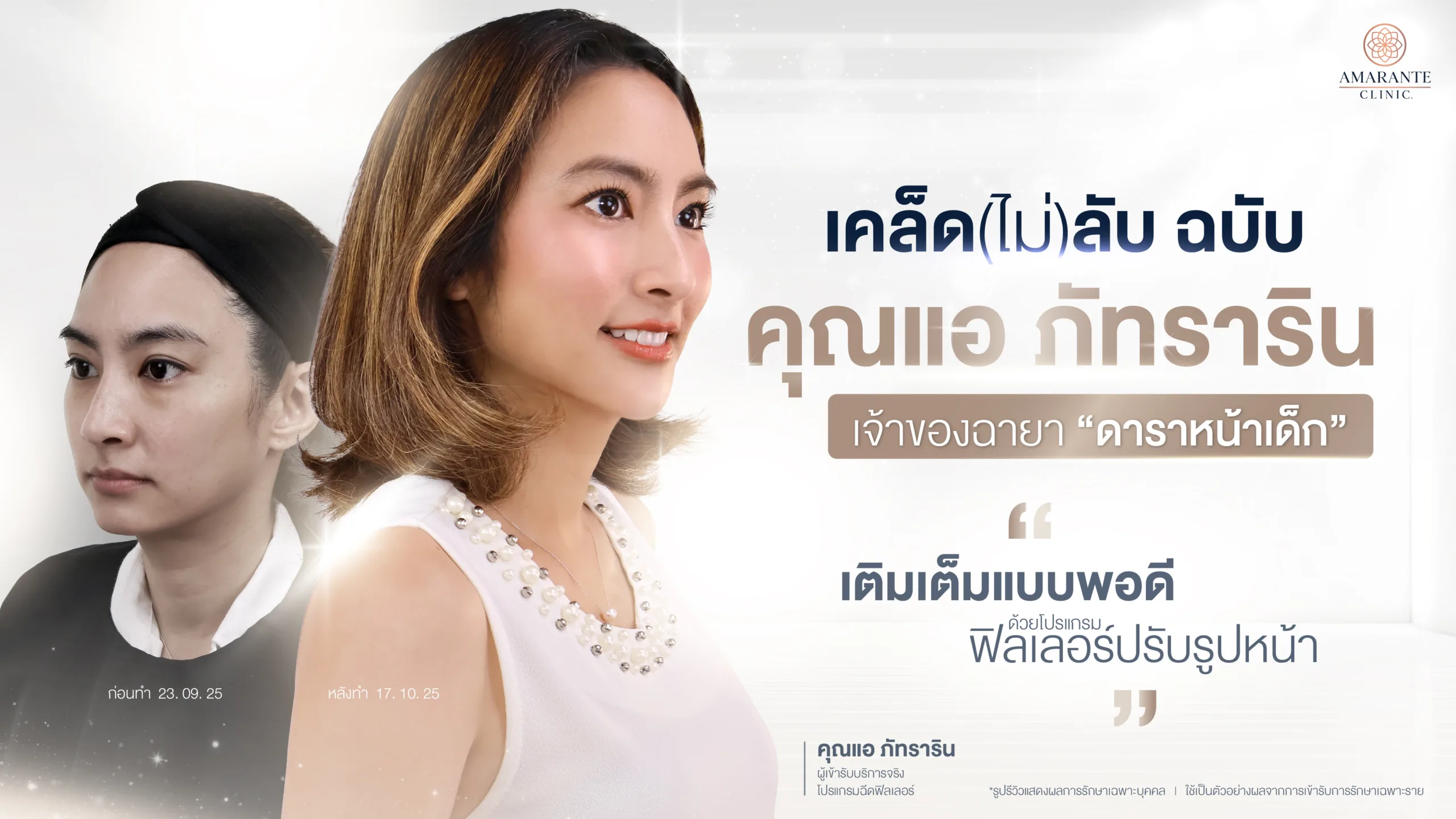 รีวิว คุณแอร์ ภัทราริน กับฟิลเลอร์ปรับรูปหน้า