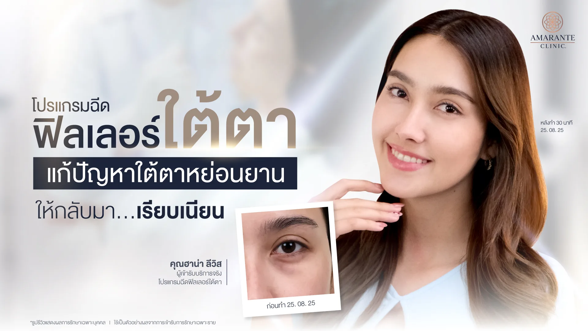 รีวิวฟิลเลอร์ใต้ตา คุณฮาน่า แก้ปัญหาใต้ตาหย่อนยาน