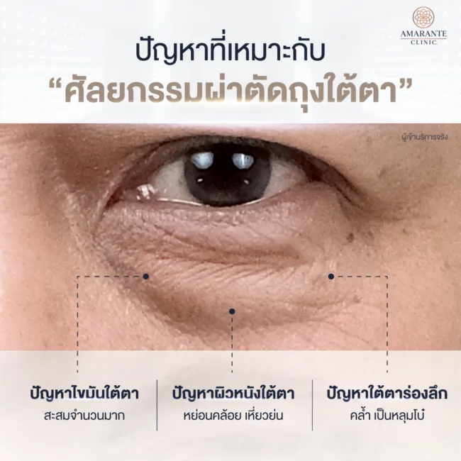 ปัญหาที่เหมาะกับการผ่าตัดถุงใต้ตา