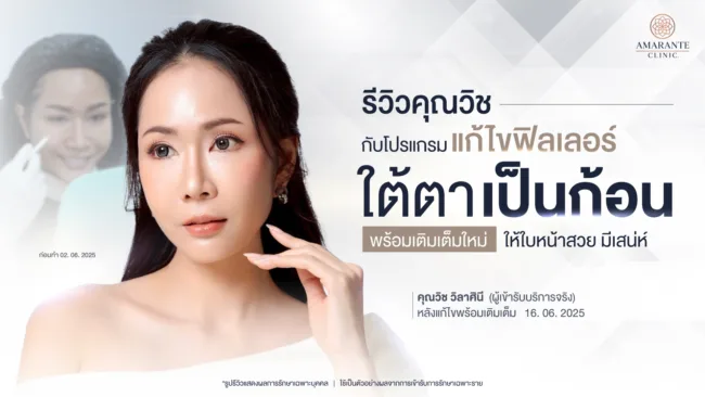 รีวิวคุณวิช แก้ไขฟิลเลอร์ใต้ตาจากเป็นก้อน พร้อมเติมใหม่