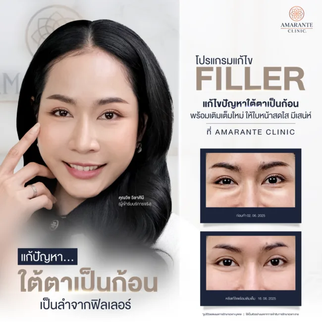 รีวิวก่อนหลังแก้ไขฟิลเลอร์ใต้ตา