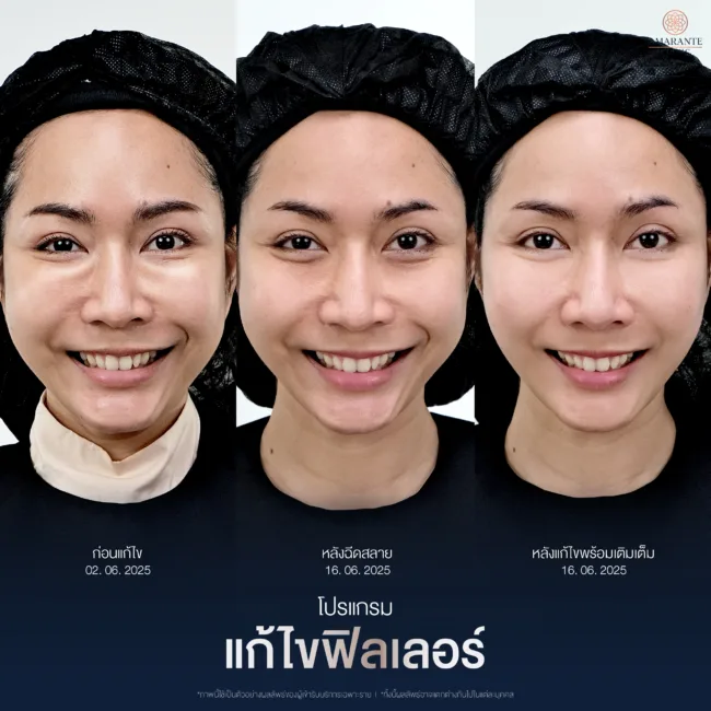 รีวิวก่อนหลัง แก้ไขปัญหาใต้ตาเป็นก้อน เป็นลำจากฟิลเลอร์ด้วยโปรแกรมแก้ไขฟิลเลอร์ใต้ตาที่ Amarante Clinic