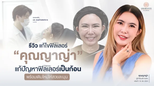 รีวิวแก้ไขฟิลเลอร์ คุณญาญ่าแก้ปัญหาฟิลเลอร์เป็นก้อน