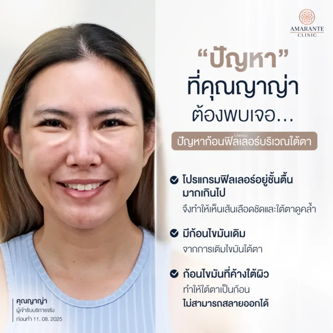 ปัญหาฟิลเลอร์เป็นก้อน