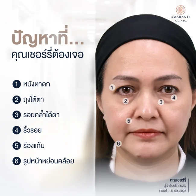 ปัญหาถุงใต้ตาห้อย หน้าดูมีอายุ