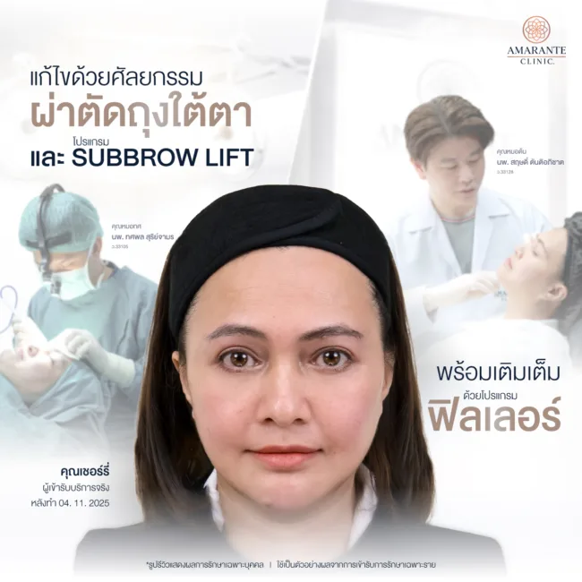 หลังผ่าตัดถุงใต้ตาและ Subbrow Lift เติมเต็มด้วย Filler