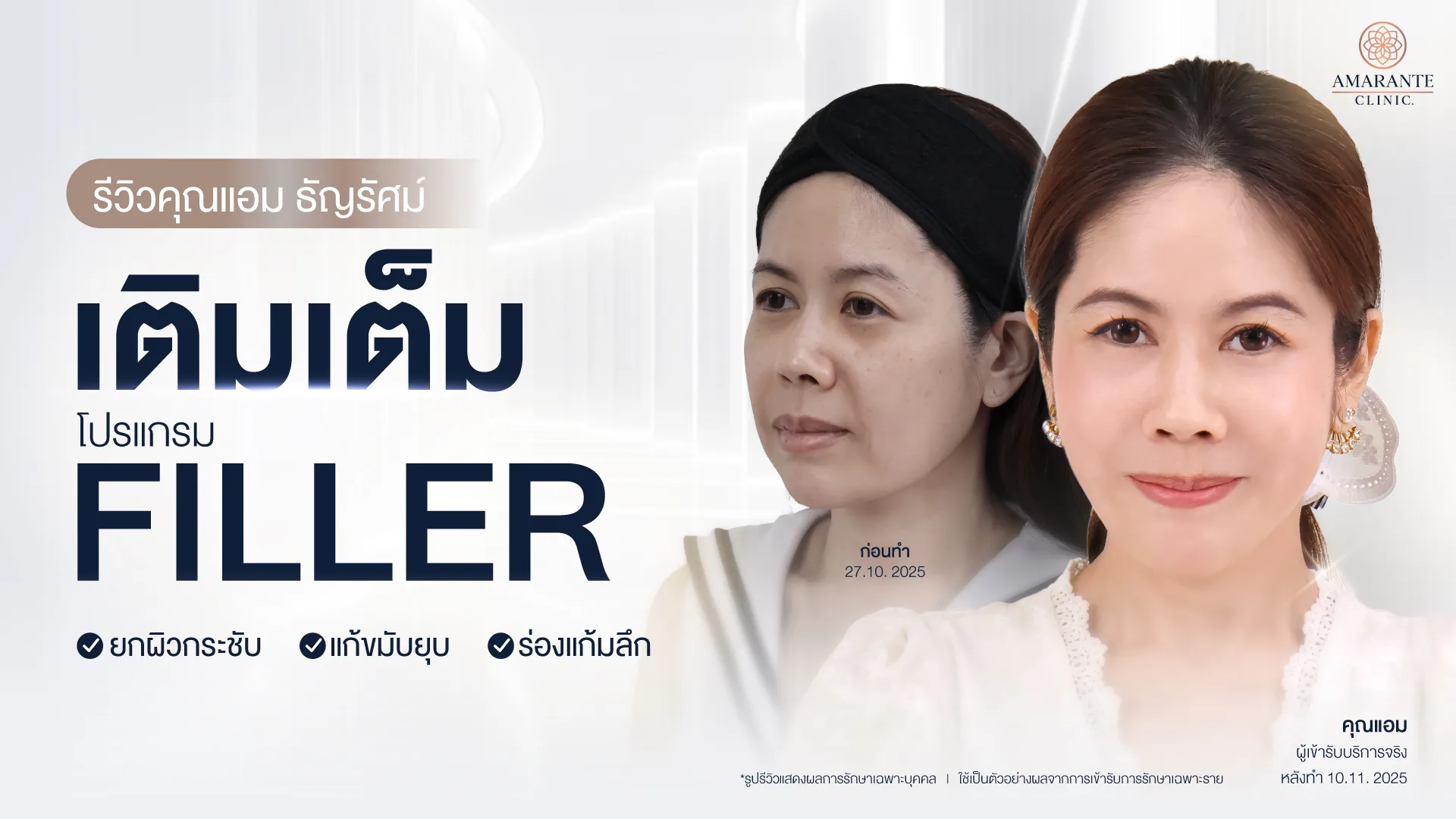 รีวิวFiller ยกผิวกระชับ แก้ขมับยุบ ร่องแก้มลึก