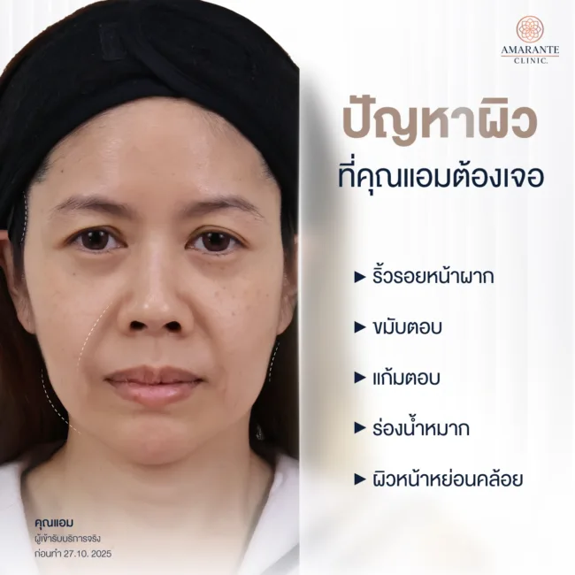ปัญหาก่อนฉีดฟิลเลอร์ ขมับยุบ ร่องแก้มลึก ปัญหาคุณแอ้มต้องเจอ