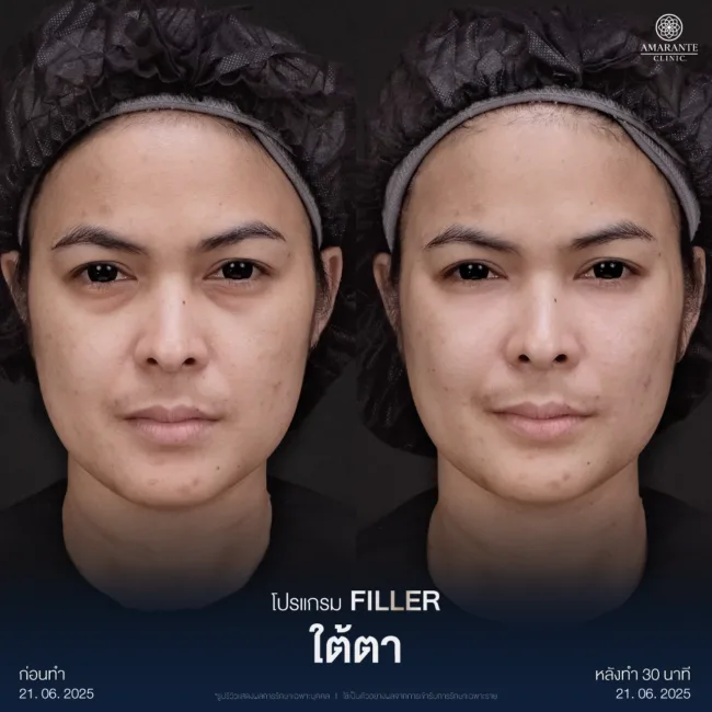 รีวิวฟิลเลอร์ใต้ตา