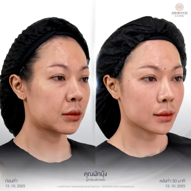 รีวิวก่อน-หลังฉีดฟิลเลอร์