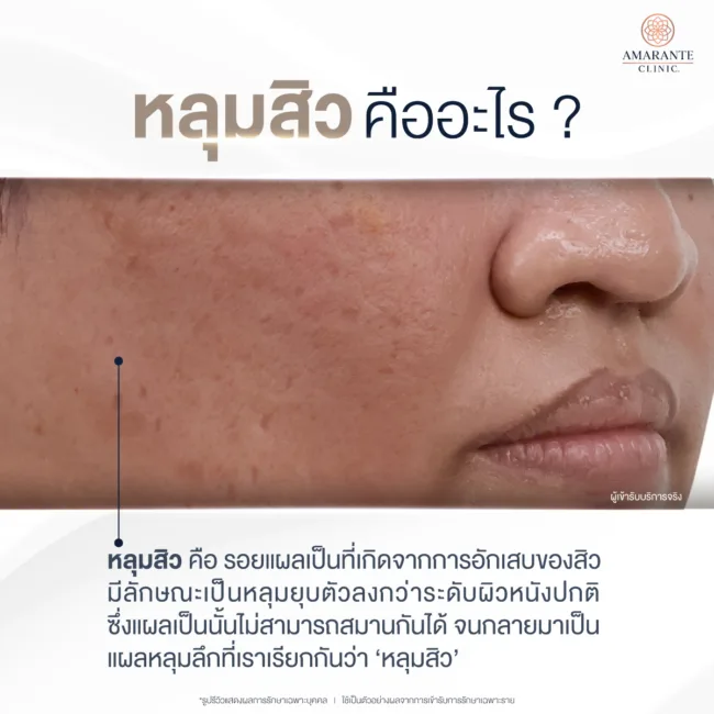 หลุมสิวคืออะไร