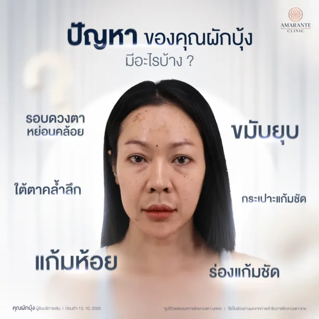 ปัญหาผิวเริ่มหย่อนคล้อย แก้มห้อย ปัญหาก่อนฉีดฟิลเลอร์