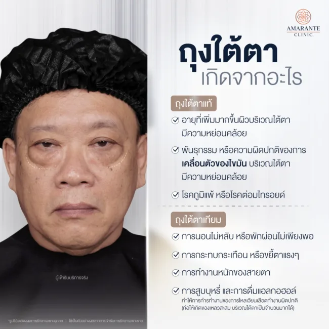 ถุงใต้ตาเกิดจากอะไร