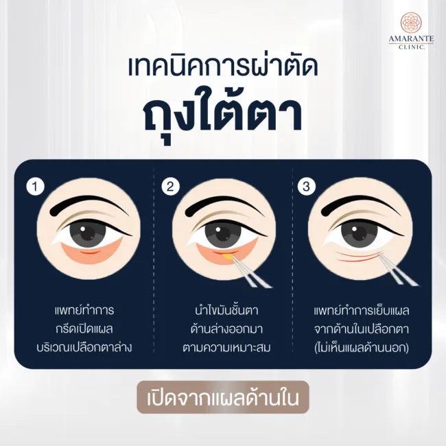 เทคนิคผ่าตัดถุงใต้ตาแผลนอก