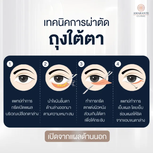 เทคนิคผ่าตัดถุงใต้ตาแผลใน
