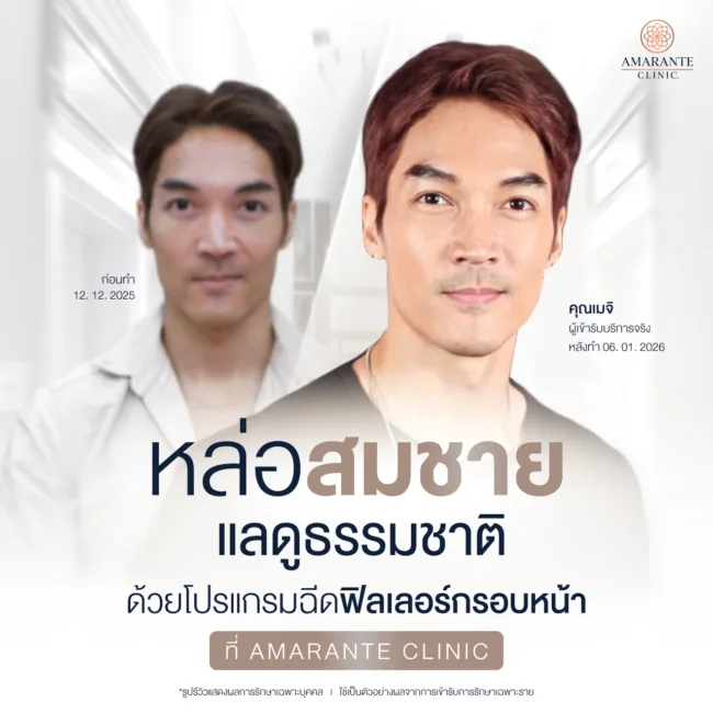 หลังฉีดฟิลเลอร์กรอบหน้าที่Amarante Clinic