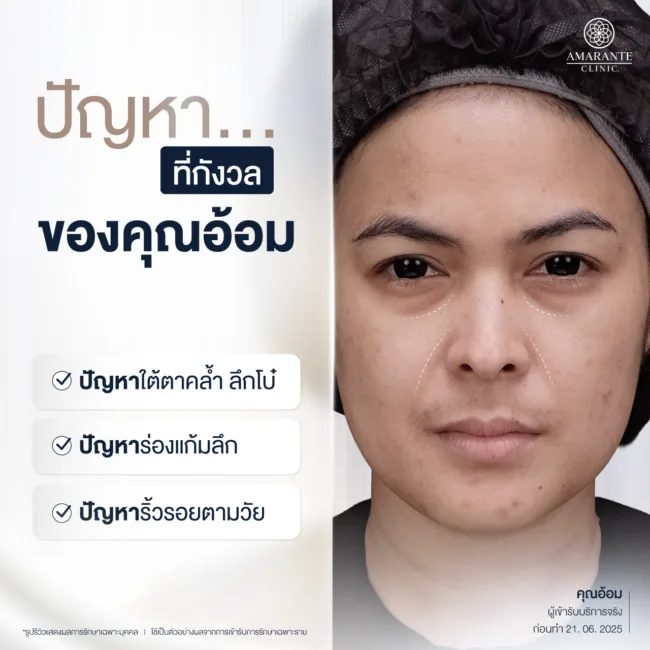 ปัญหาใต้ตาลึก คล้ำ ก่อนฉีดฟิลลอร์