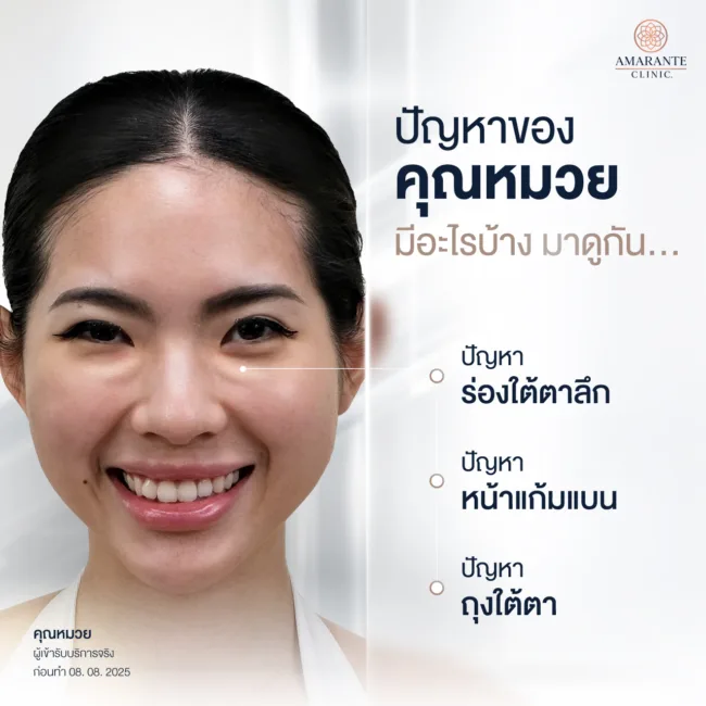 ปัญหาหน้าล้น ใต้ตาเป็นก้อน ขยับตอบ จากการฉีดฟิลเลอร์ที่อื่นมา