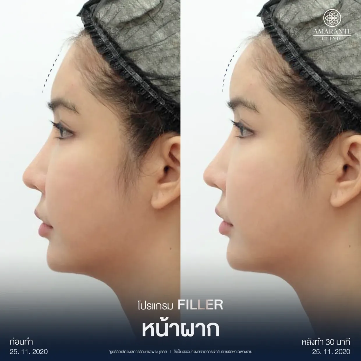 รีวิวฉีดฟิลเลอร์หน้าผาก