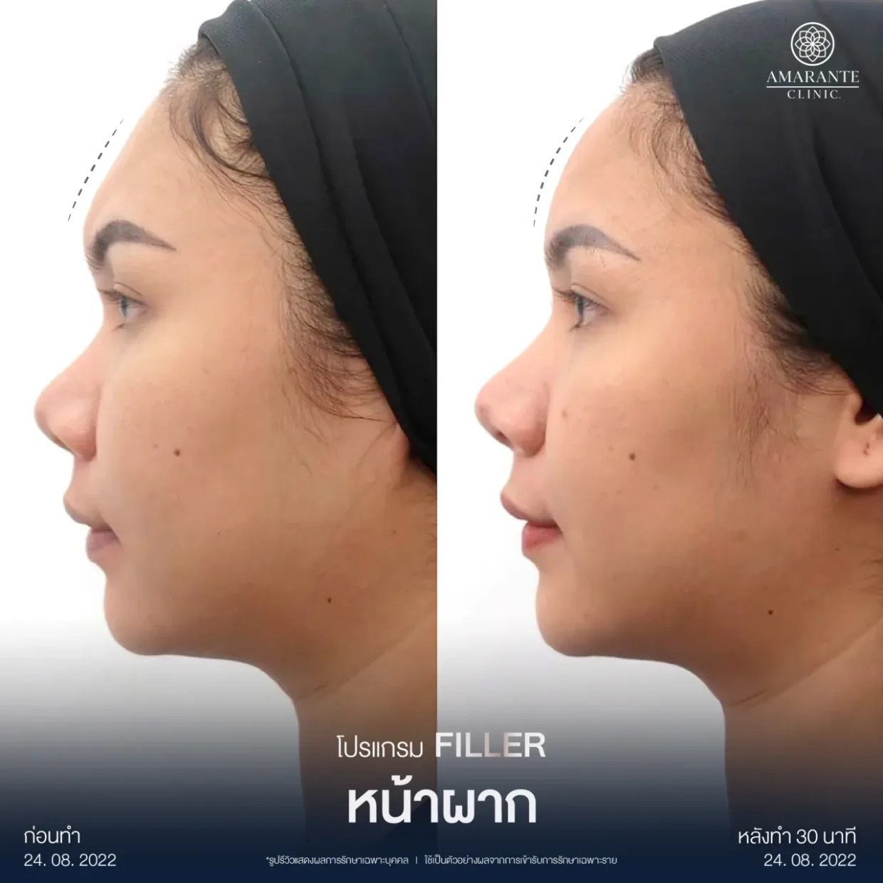 รีวิวฉีดฟิลเลอร์หน้าผาก