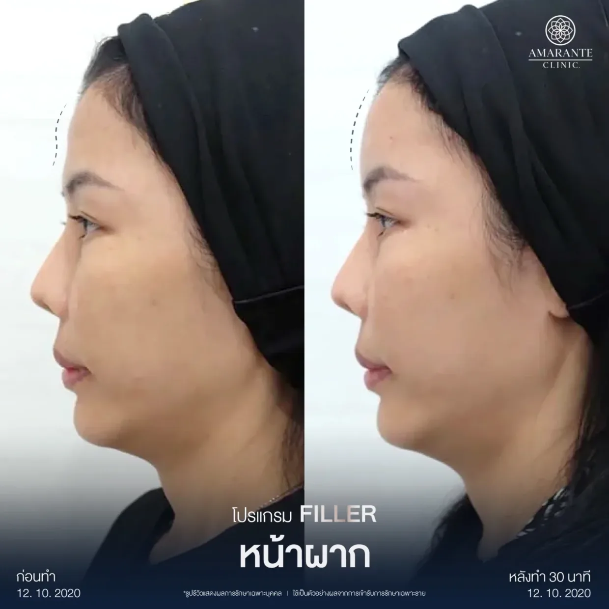 รีวิวฉีดฟิลเลอร์หน้าผาก