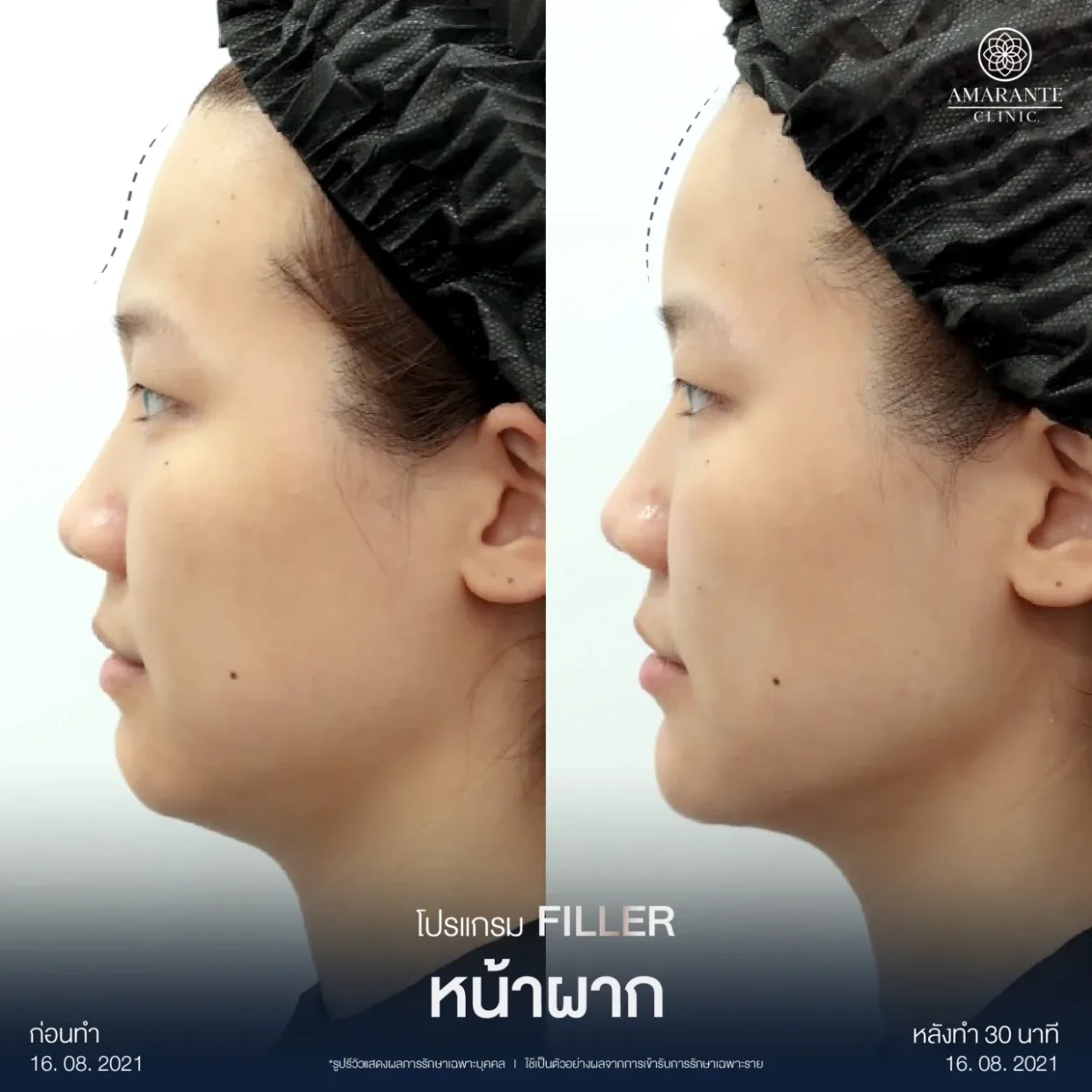 รีวิวฉีดฟิลเลอร์หน้าผาก