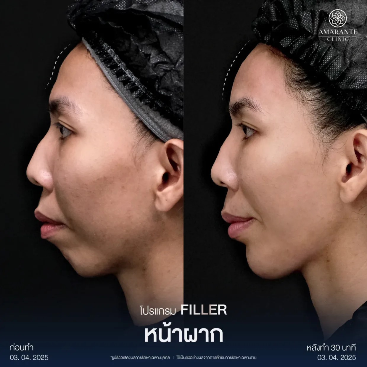 รีวิวฉีดฟิลเลอร์หน้าผาก