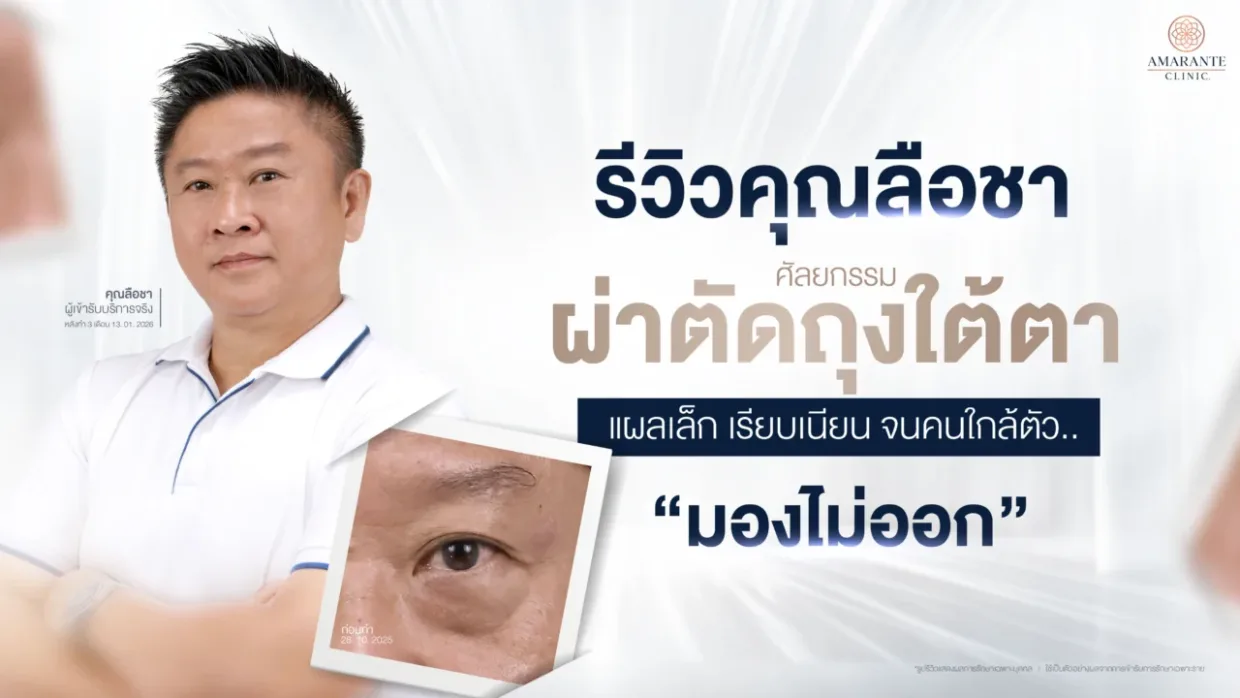 รีวิวผ่าตัดถุงใต้ตาแผลเล็ก ที่ Amarante Clinic