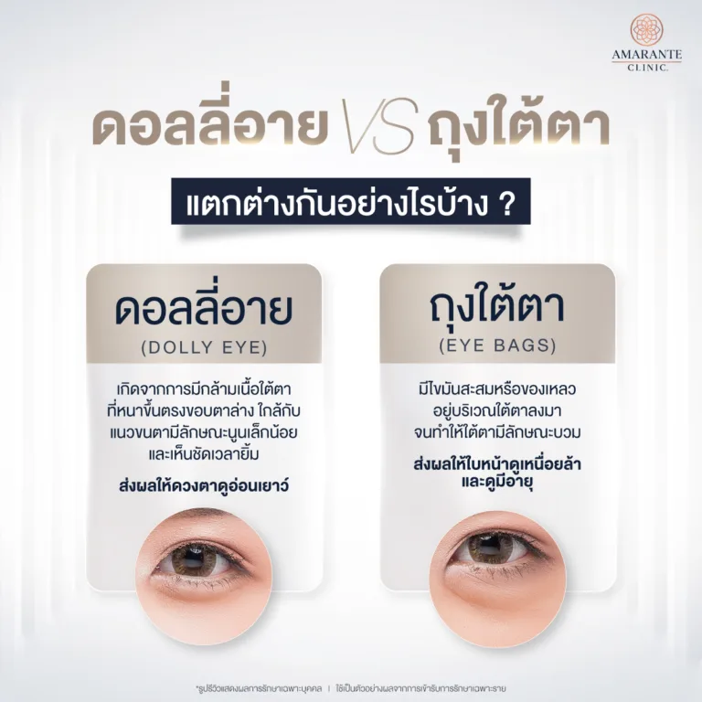 ความแตกต่างของดอลลี่อายกับถุงใต้ตา