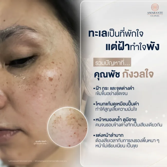 ปัญหาฝ้า กระ และจุดด่างดำแก้ด้วยpico