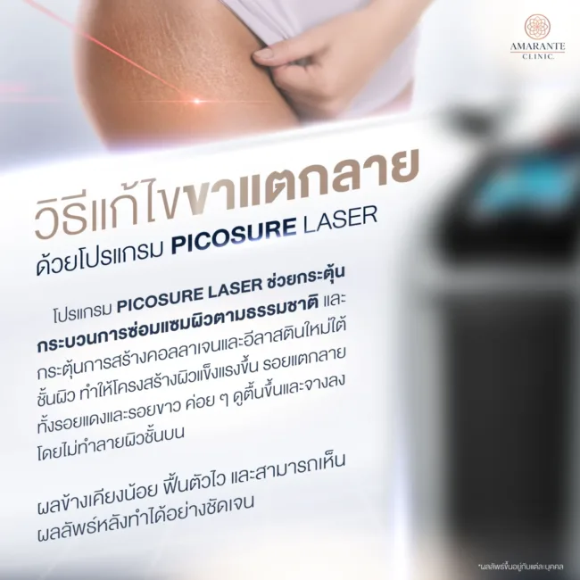 วิธีแก้ไขขาแตกลายด้วย Picosure Laser
