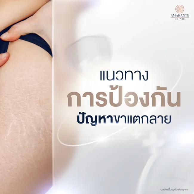 ป้องกันไม่ให้ขาแตกลาย