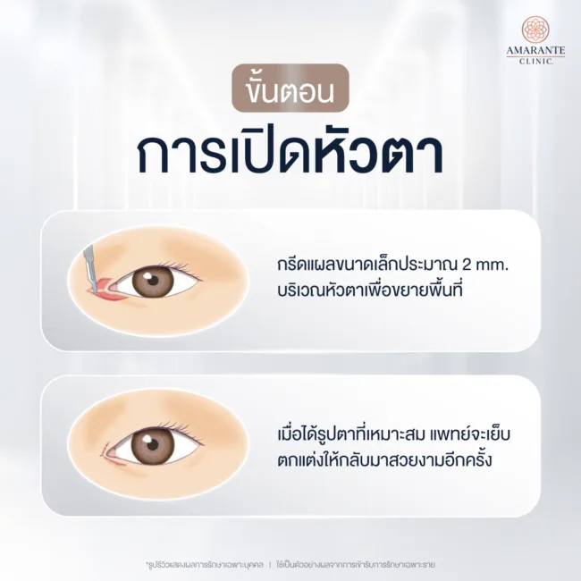 ขั้นตอนการเปิดหัวตา