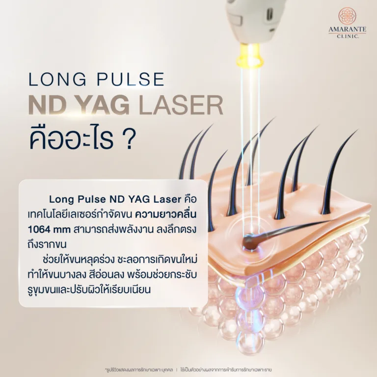 Long Pulse ND YAG Laser คืออะไร