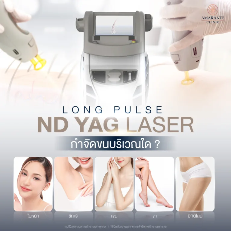 Long Pulse ND YAG Laser กำจัดขนบริเวณใดได้บ้าง