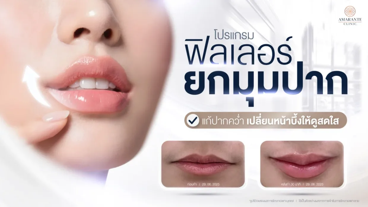 ฉีดฟิลเลอร์ยกมุมปาก แก้ปากคว่ำ เปลี่ยนหน้าบึ้งให้ดูสดใสขึ้น