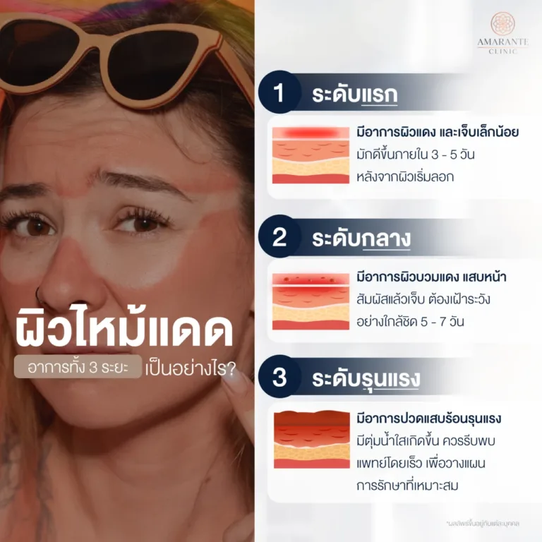 อาการหน้าไหม้แดด
