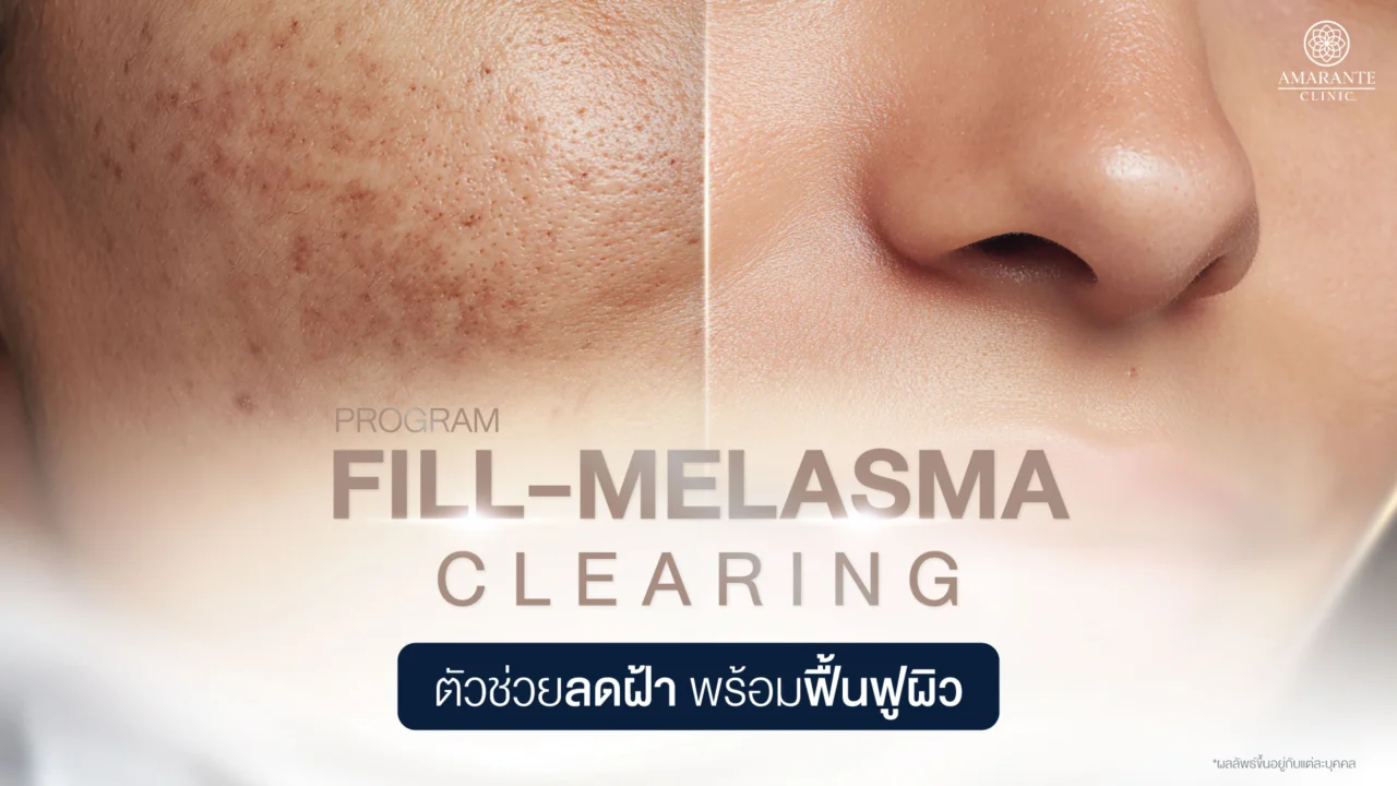 Meso ฝ้า Fill-Melasma Clearing ลดฝ้า ช่วยฟื้นฟูผิว เสริมเกราะป้องกัน