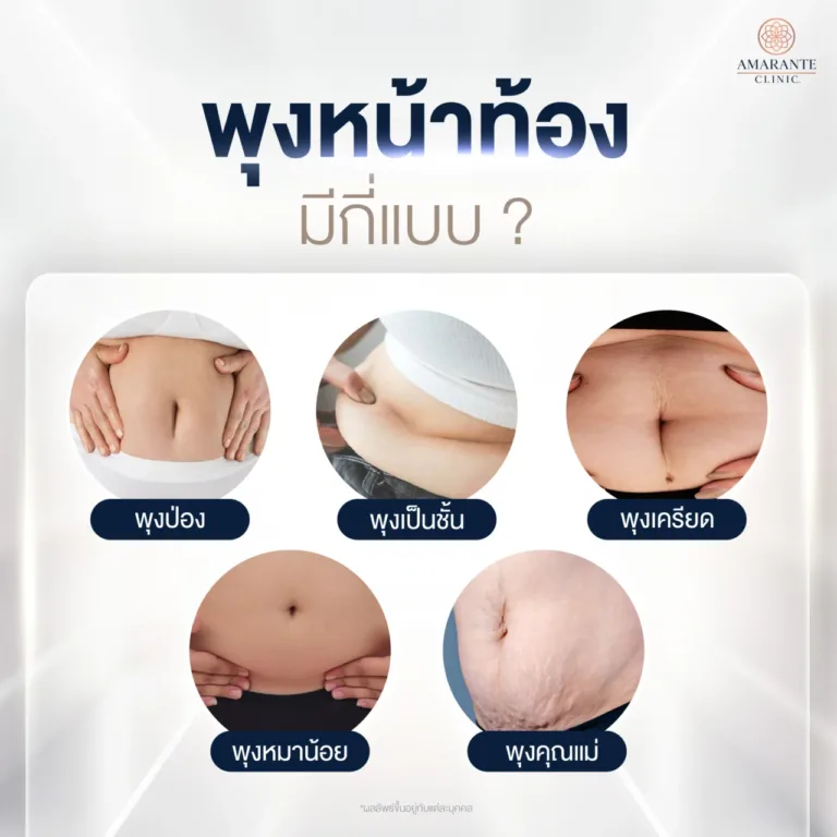 พุงหน้าท้องมีกี่แบบ ?