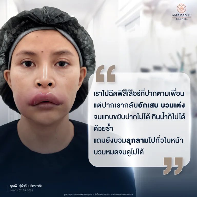 เพราะเชื่อหมอกระเป๋าทำให้คุณพี เจอกับความผิดปกติหลังฉีดฟิลเลอร์ปาก บวม อักเสบ ไม่มีที่ไหนรับแก้