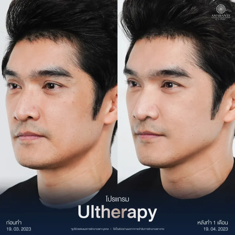 รวม BA Ultherapy-01-08