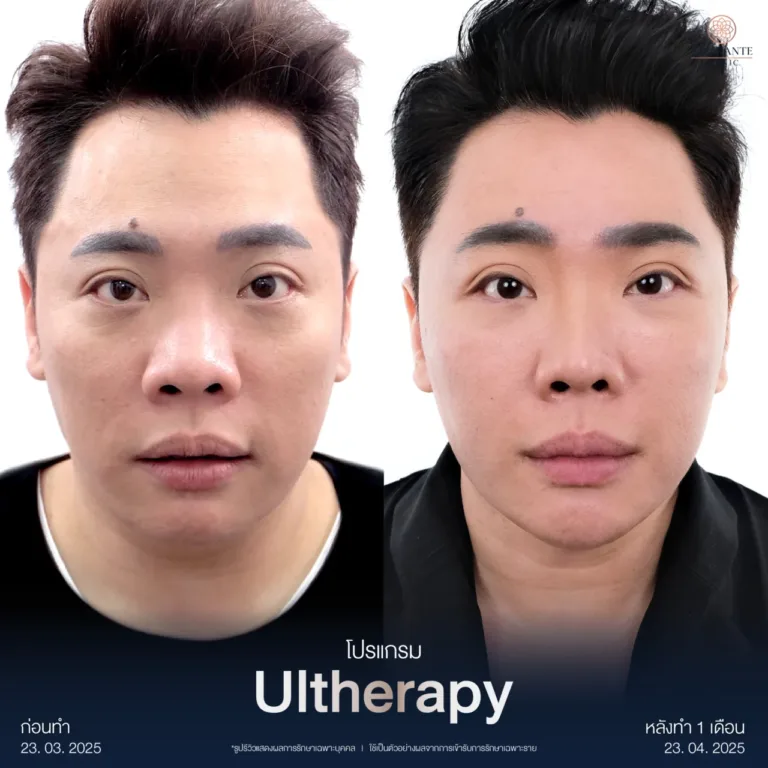 รวม BA Ultherapy-02