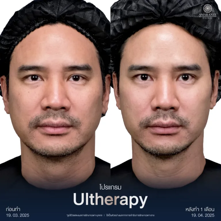 รวม BA Ultherapy-03