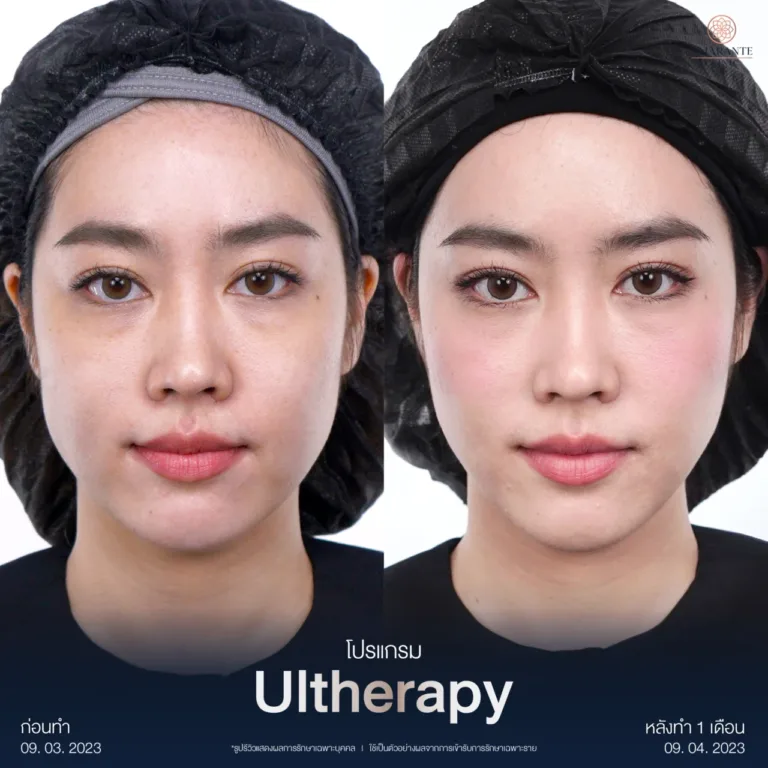 รวม BA Ultherapy-06