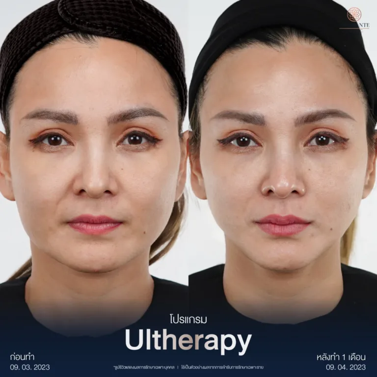 รวม BA Ultherapy-07