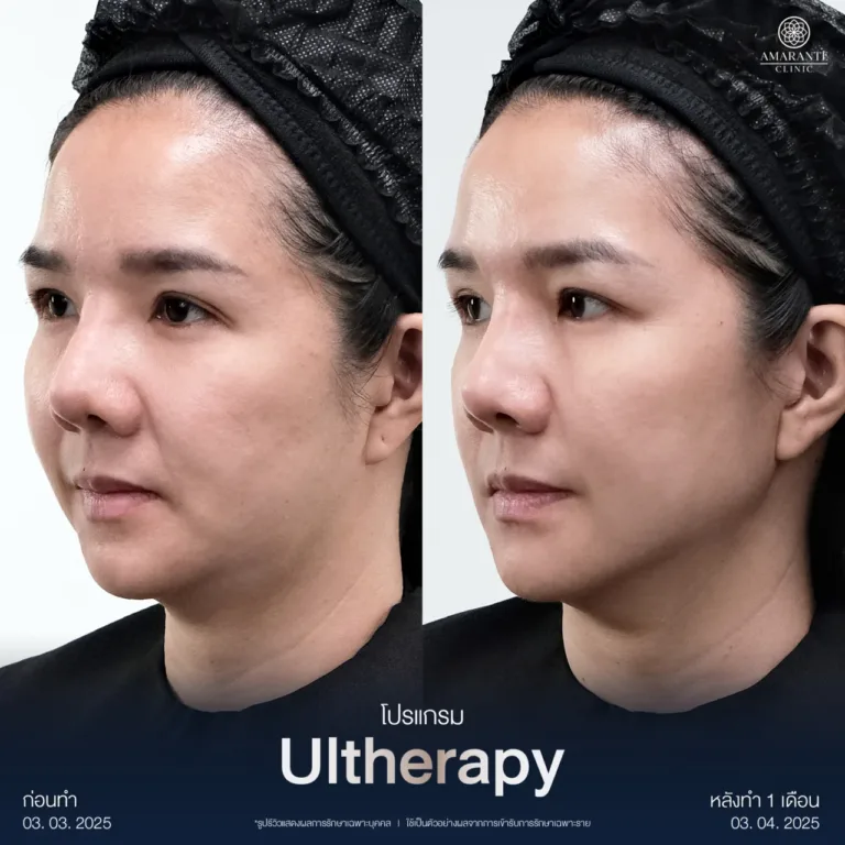 รวม BA Ultherapy-09